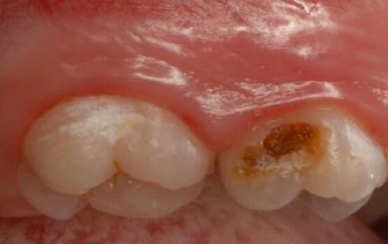 Ученые обнаружили бактерии, которые ускоряют процесс распада зубов