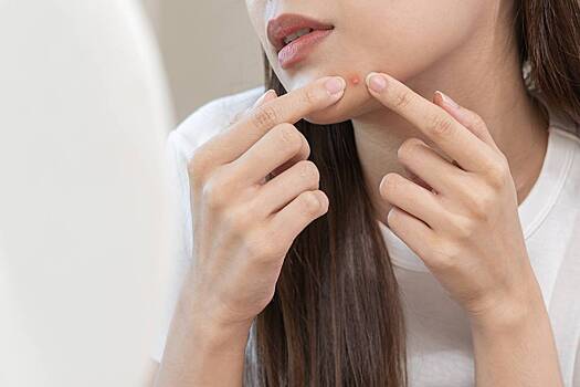 Врач назвал единственный верный способ выдавливать прыщи дома