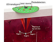 Ультразвук позволил лазеру заглянуть внутрь тела