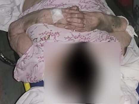Пожилую пенсионерку в Сургуте выписали из COVID-госпиталя в одном памперсе и с синяками