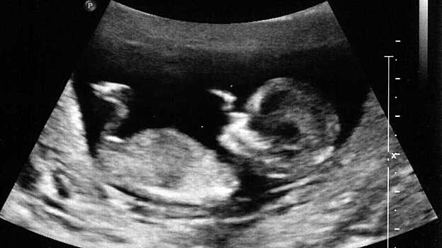 В США появился на свет первый в стране ребенок женщины, родившейся без матки