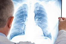 «Без жалоб»: пневмонию при COVID-19 можно не заметить