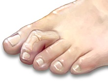 Молоткообразная деформация пальцев стоп: причины, симптомы и лечение