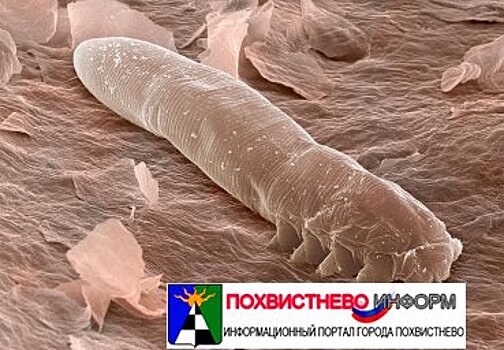 «Под кожей что-то ползает»: Самарские врачи рассказали, как защитить себя от глазного клеща