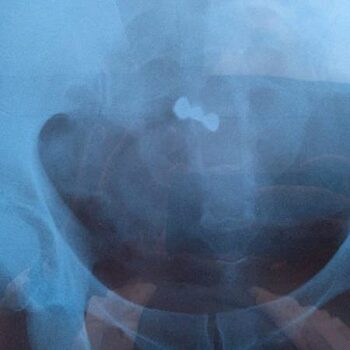 Минздрав МО: подмосковные врачи спасли женщину, проглотившую зубной протез