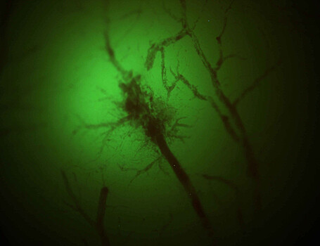 Ученые пронаблюдали, что происходит в нервных клетках при инсульте