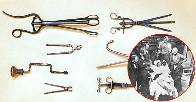 Странные и пугающие медицинские инструменты из прошлого