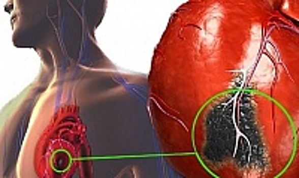 В НИУ «МИЭТ» учеными разработана конструкция для устранения дефектов сердца