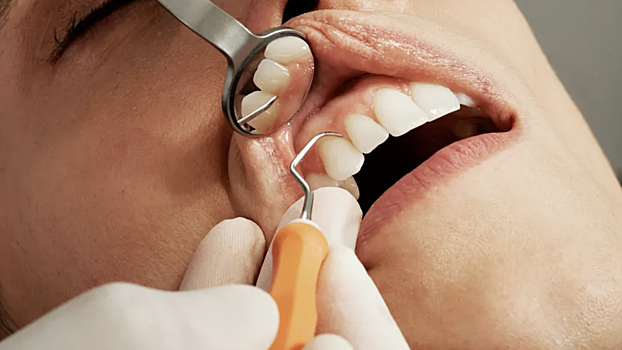 Стоматолог Лебедева: если пломба откололась, лучше как можно скорее обратиться ко врачу
