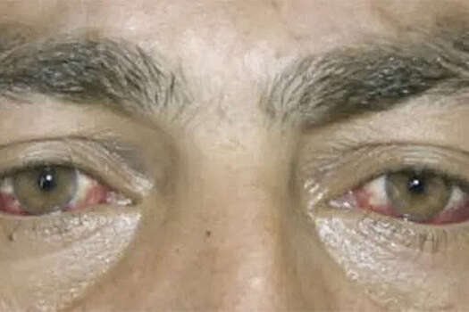 Испанца госпитализировали с кровотечением из глаз, вызванным опасной болезнью