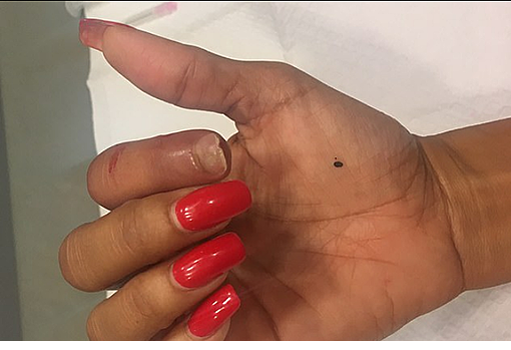 Американка отрастила откушенный пумой палец