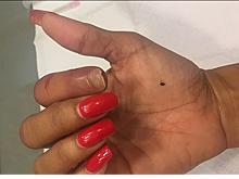 Американка отрастила откушенный пумой палец