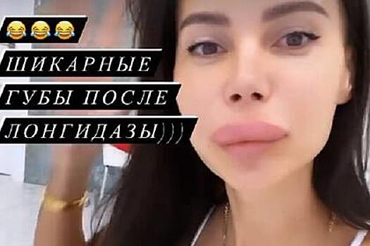 Оксана Самойлова решила уменьшить губы и получила отек