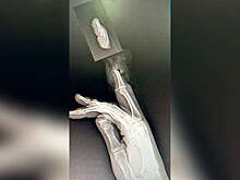 В Москве двум школьницам пришили пальцы, оторванные из-за колец