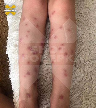 Врач рассказал о последствиях церкариоза