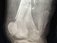 Инженеры смоделировали вытекание крови из простреленной ноги