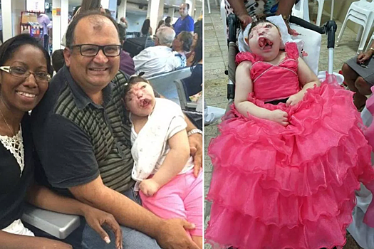 Девочка без лица жива уже 9 лет, несмотря на прогнозы врачей