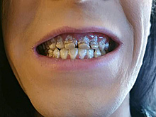 Энергетические напитки разрушили зубы и жизнь британца