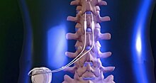Стимуляция спинного мозга помогла при болезни Паркинсона