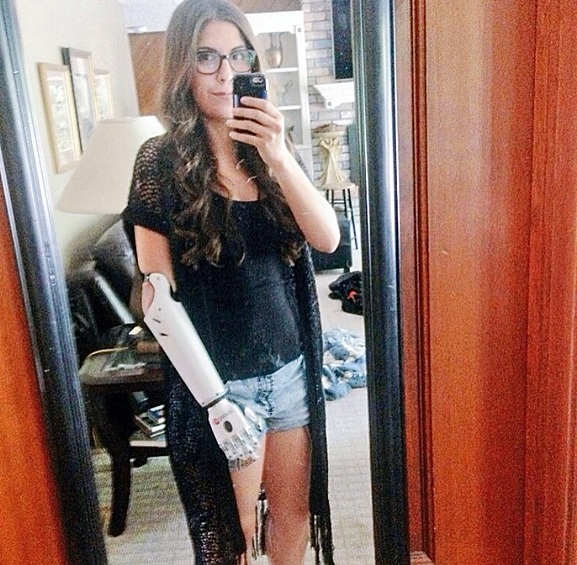 А это Анжел Гиуфрия из США. У нее врожденная патология левой руки. Она родилась без кисти и предплечья, но свой первый протез она получила уже в 4 месяца.