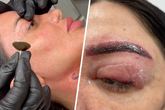 Овсепян заявила, что косметолог специально изуродовала ее лицо
