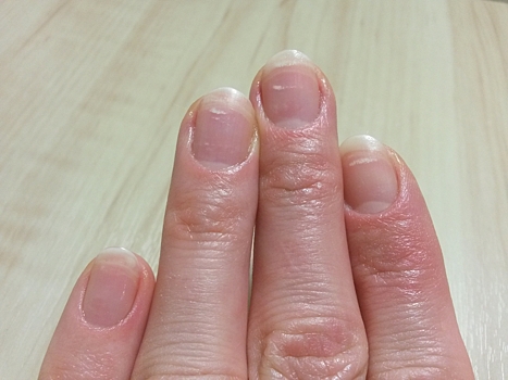 О каких болезнях говорит специфичный цвет ногтей