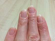 О каких болезнях говорит специфичный цвет ногтей