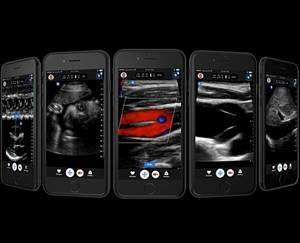 Как ученым удалось превратить iPhone в полноценный УЗИ-аппарат