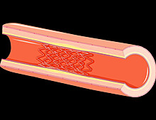 Разработано новое полимерное покрытие для стентов