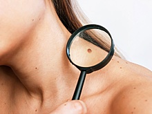Онколог рассказал, что делать если травмировалась родинка