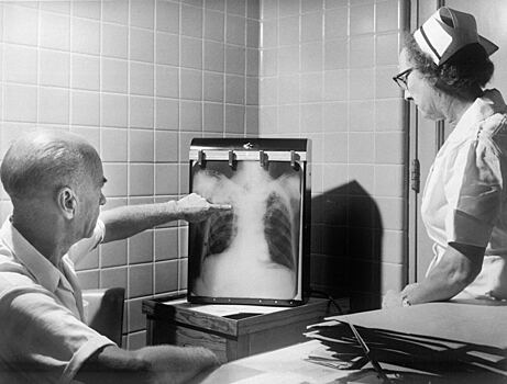 Фтизиатр развеяла самые живучие мифы о туберкулезе