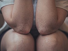 Дерматовенеролог рассказала о методах избавления мозолей на локтях