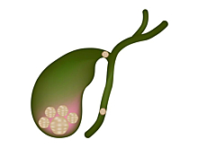 «Немедленно к хирургу!»: кузбасский врач рассказал об опасной и частой болезни