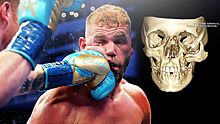 Страшная травма в боксе. Альварес сломал лицо сопернику одним ударом