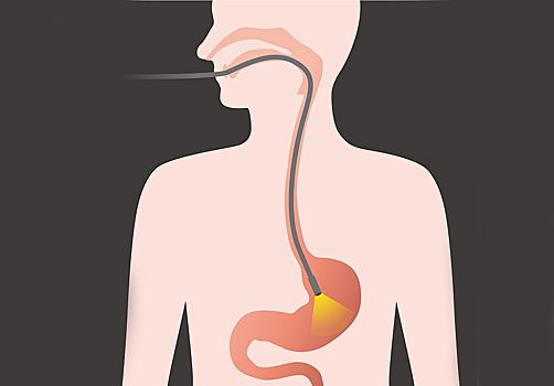 Гастроскопия: как ее пережить без страданий