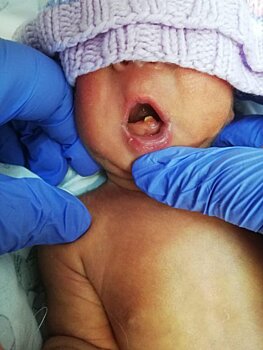 Врачи Мытищинской больницы обнаружили у новорожденной зуб