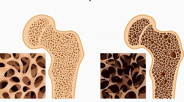 Остеопороз — причины, лечение