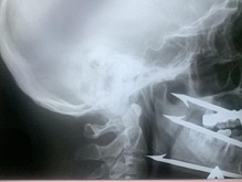 Хирурги спасли загарпунившего себя рыбака