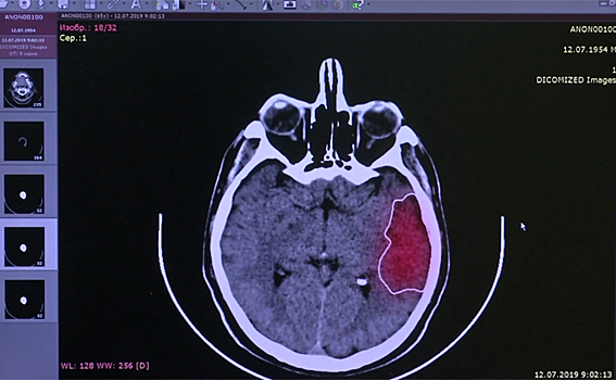 Инсульт с помощью нейросети диагностируют новосибирские медики