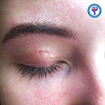 В Астрахани врачи вытащили из глаза девушки 12-сантиметрового червя