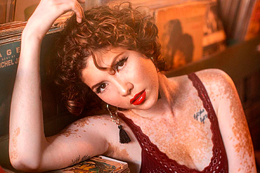 Модель с заболеванием кожи рассказала о пережитых из-за недуга издевательствах