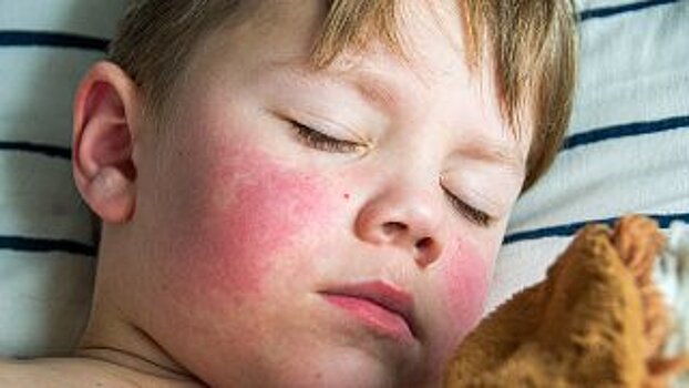 Красные щёки у ребёнка: норма или патология? Отвечает педиатр