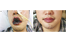 Мужчина пожаловался на кашель и внезапно приобрел почерневшие губы