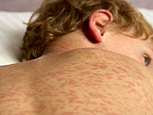 В Ростовскую область для семи тысячи детей поставят вакцину от кори