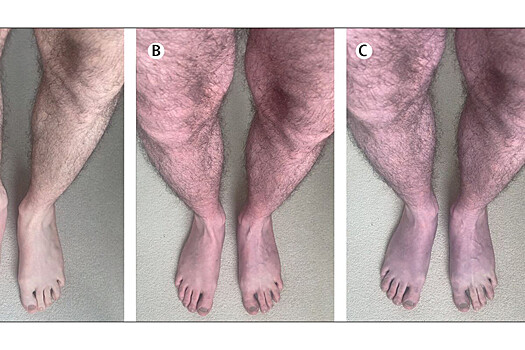 В Англии у больного ковидом мужчины посинели ноги