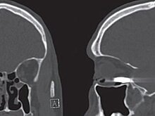 Получшивший пулю в глаз мужчина практически не пострадал