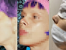 Еще осталась должна: волгоградка рассказала о последствиях ринопластики