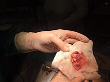 Тюменке удалили опухоль с зубами и волосами внутри