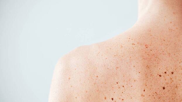 Рак кожи: симптомы, неочевидные признаки и методы лечения