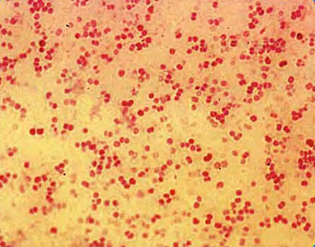 Открыт новый передающийся половым путем штамм менингококка